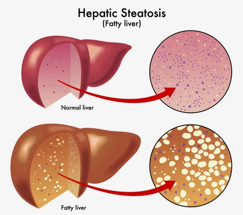 Healthy Lifestyle, Diet and Optimal Supplementation Can Prevent Fatty Liver